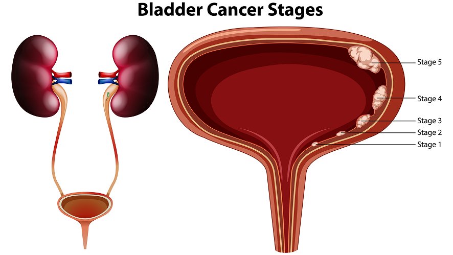 Urothelial Cancer