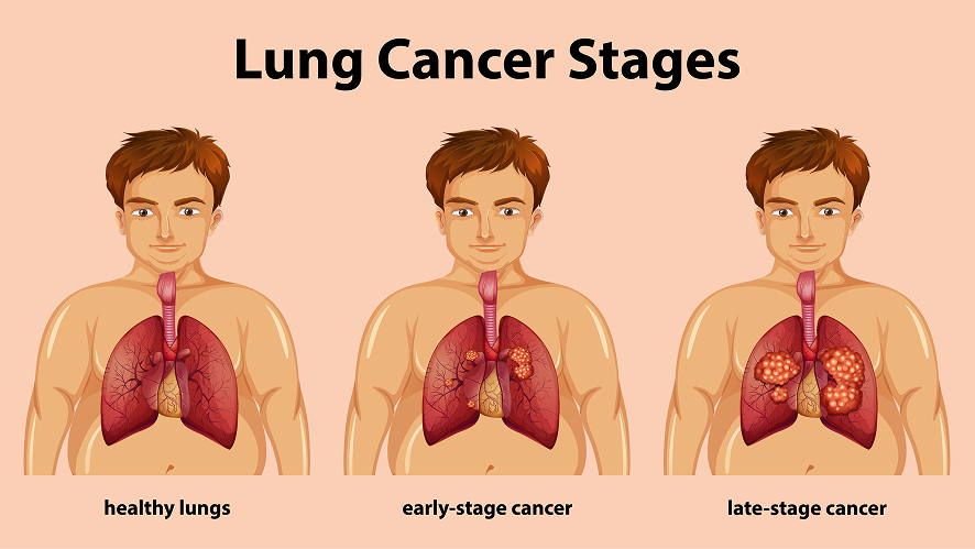 Lung Cancer