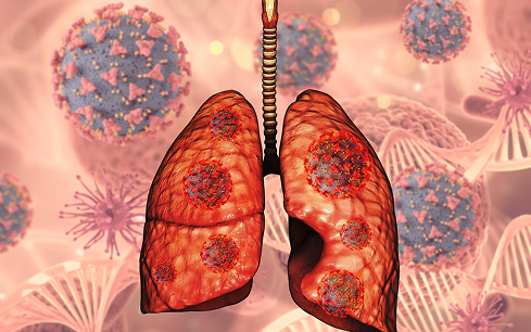 Lung Cancer
